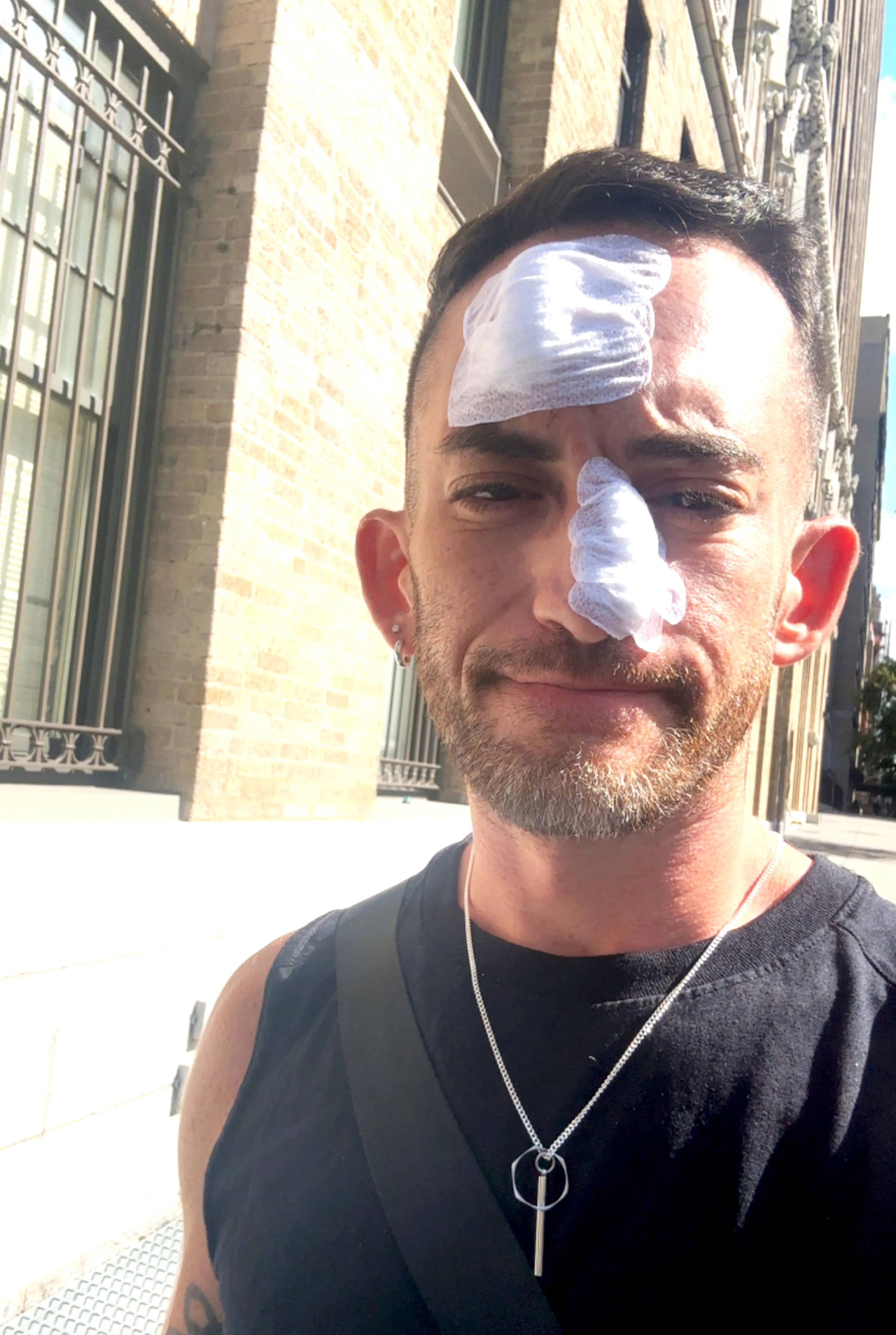 I Skipped Sunscreen on My Runs for Years. Then I Needed Skin Cancer Surgery on My Face.